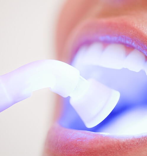 teeth whitening