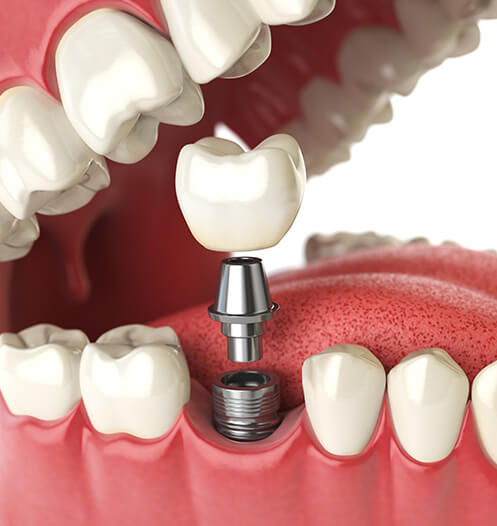 illustration of a dental implant