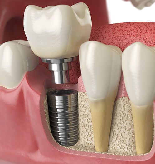 illustration of a dental implant