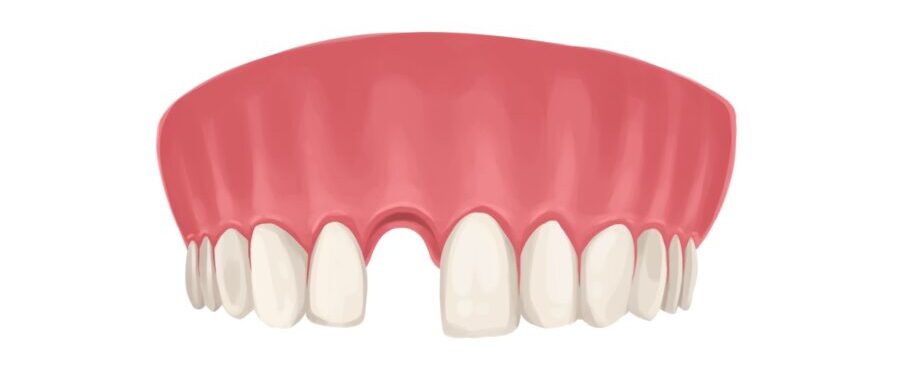 Illustration of an upper arch missing an adult front tooth that needs a tooth replacement