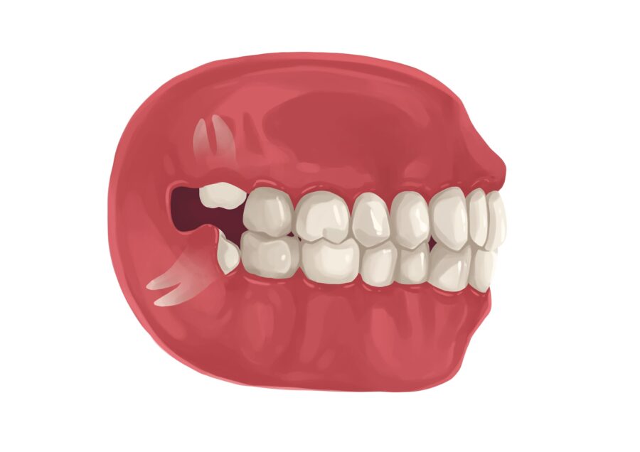 Illustration of a partially impacted wisdom tooth that needs to be removed