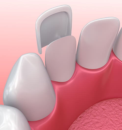 illustration of a dental veneer