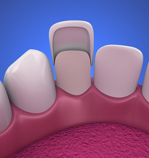 illustration of a dental veneer