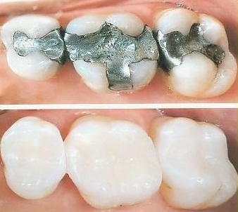 Aerial view of silver amalgam fillings above 3 teeth with tooth-colored composite dental fillings