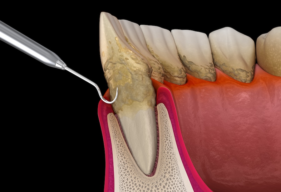 how do dentists treat gum disease, gum disease treatment, periodontal disease, Imperial Christina Dental Care, Lakeland FL, Dr. Marc Rasmussen