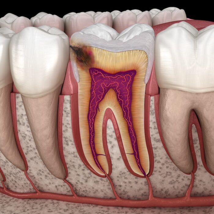 dark spots on teeth, tooth extraction, dental decay, tooth discoloration, cavities, dentist in Lakeland, FL, Imperial Christina Dental Care, save a tooth, dental treatment options, tooth health